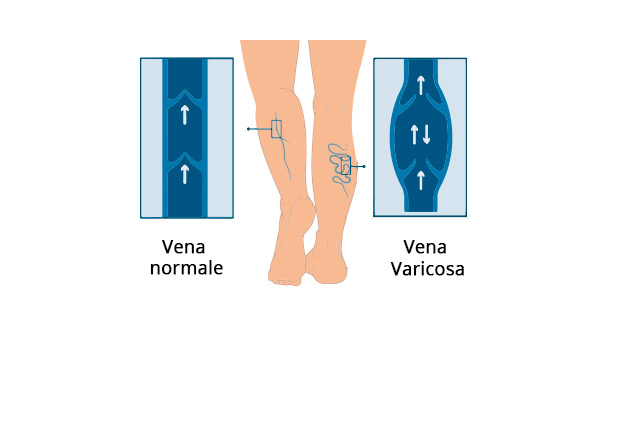 venous stasis retinopathy unilateral
